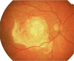 Age Related Macular Degeneration